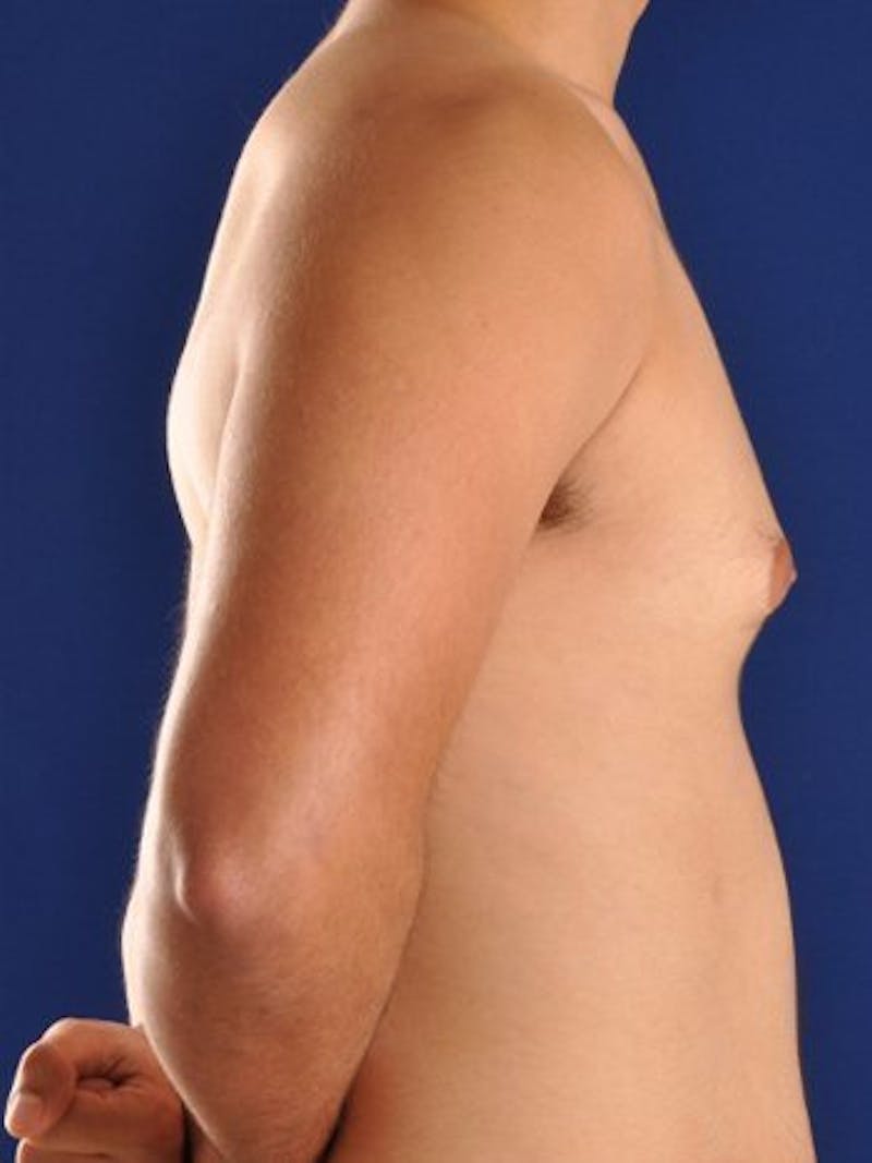 Gynecomastia Before & After Gallery - Patient 18268088 - Image 3