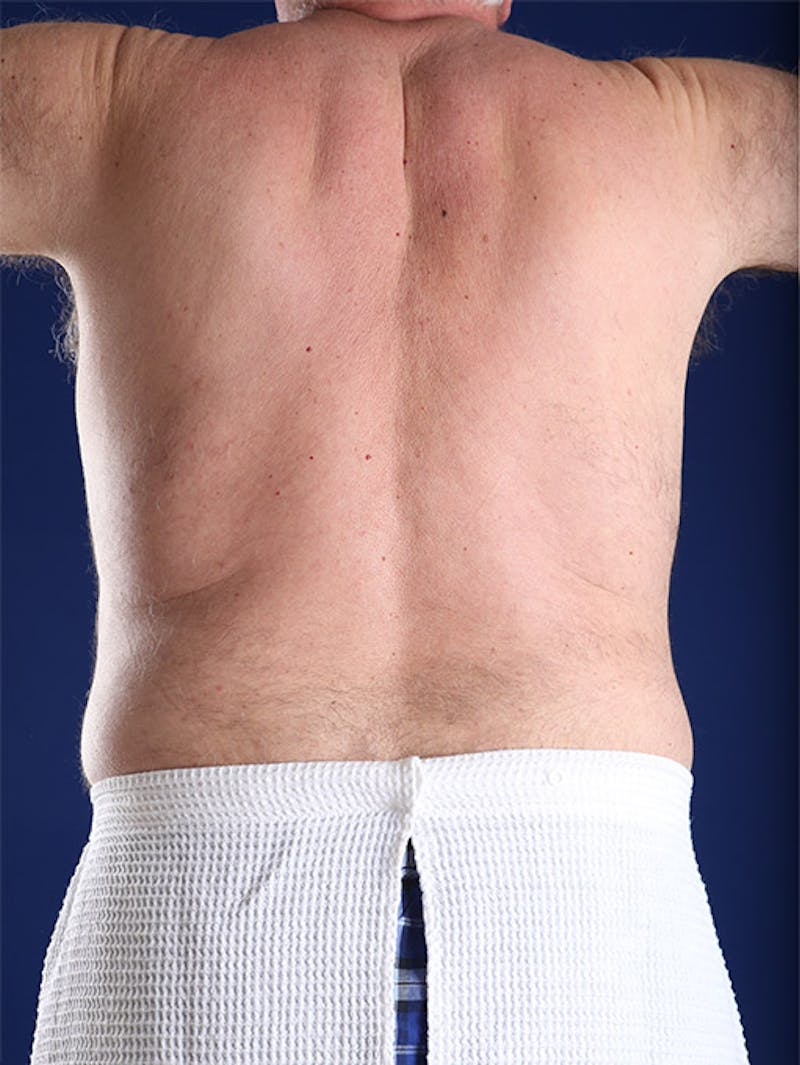 Liposuction Before & After Gallery - Patient 18268089 - Image 9