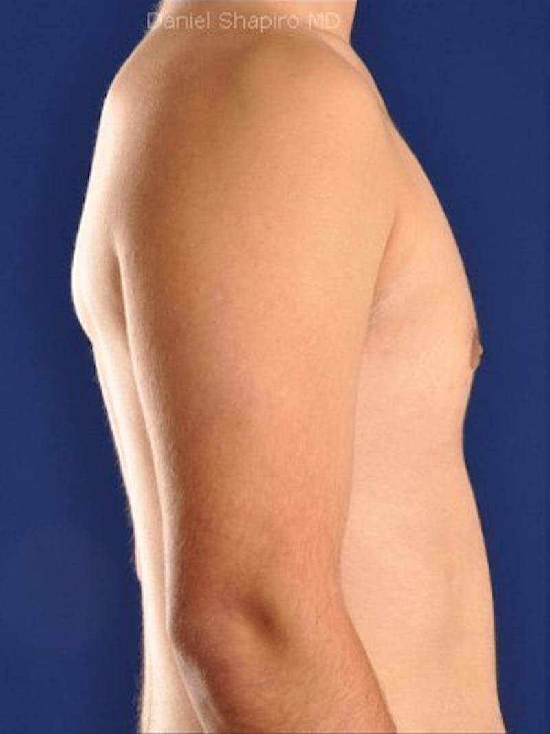 Gynecomastia Before & After Gallery - Patient 18268088 - Image 4
