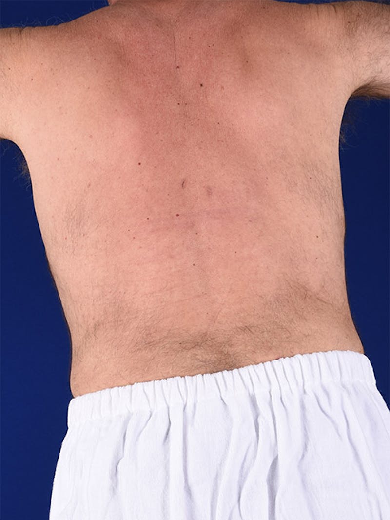 Liposuction Before & After Gallery - Patient 18268089 - Image 10