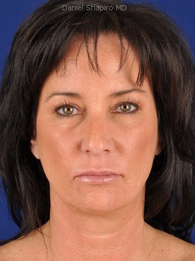 Lip Augmentation Before & After Gallery - Patient 18268094 - Image 2