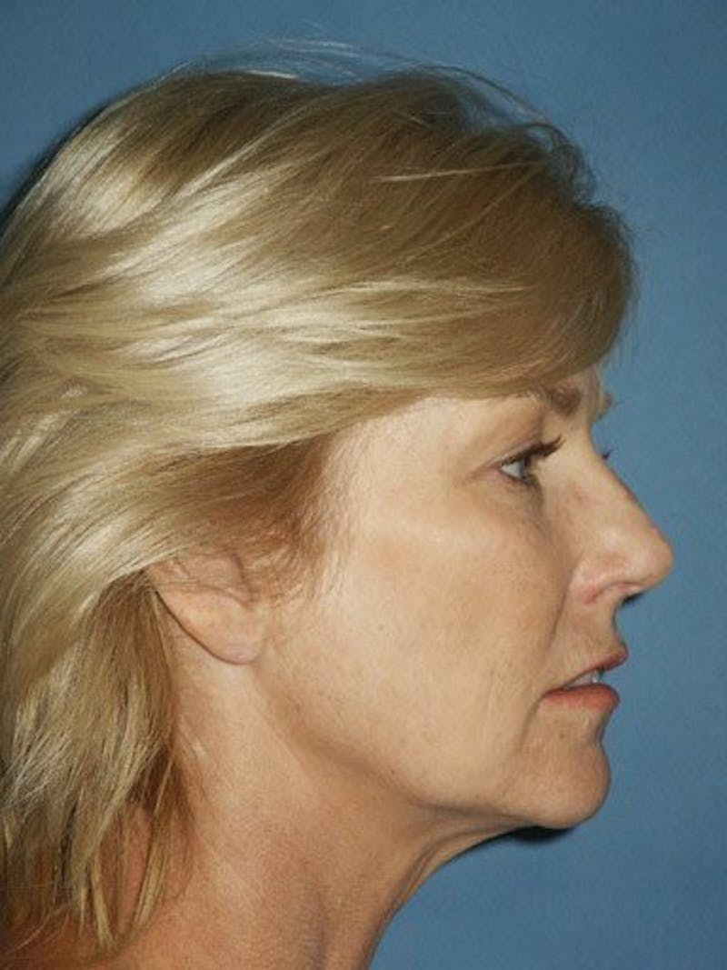 Lip Augmentation Before & After Gallery - Patient 18268107 - Image 3