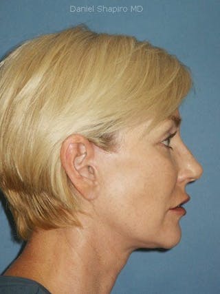 Lip Augmentation Before & After Gallery - Patient 18268107 - Image 4