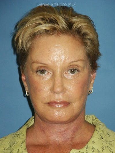 Lip Augmentation Before & After Gallery - Patient 18268113 - Image 2