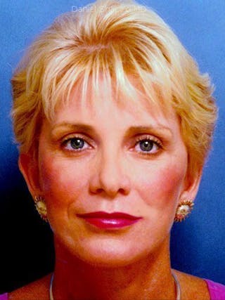 Lip Augmentation Before & After Gallery - Patient 18268114 - Image 2