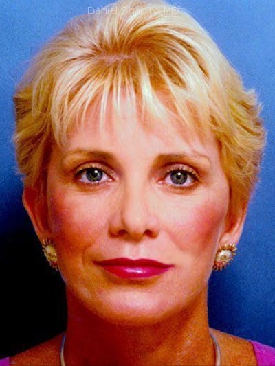 Lip Augmentation Before & After Gallery - Patient 18268114 - Image 2