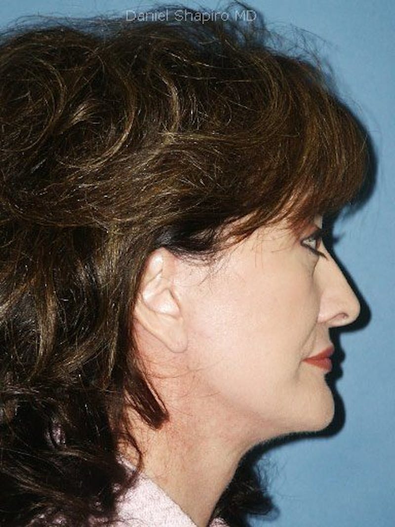 Lip Augmentation Before & After Gallery - Patient 18268116 - Image 4