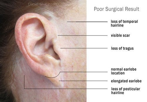 Ear Infographic