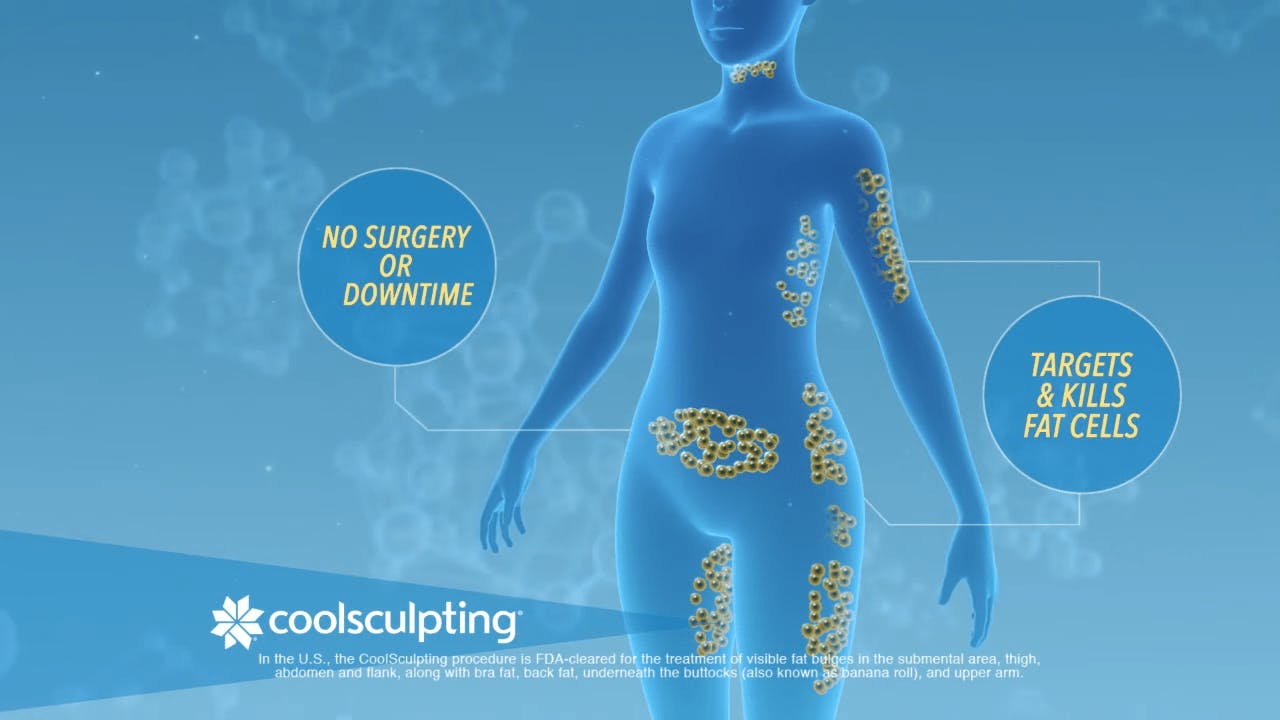 Cool Sculpting Infographic