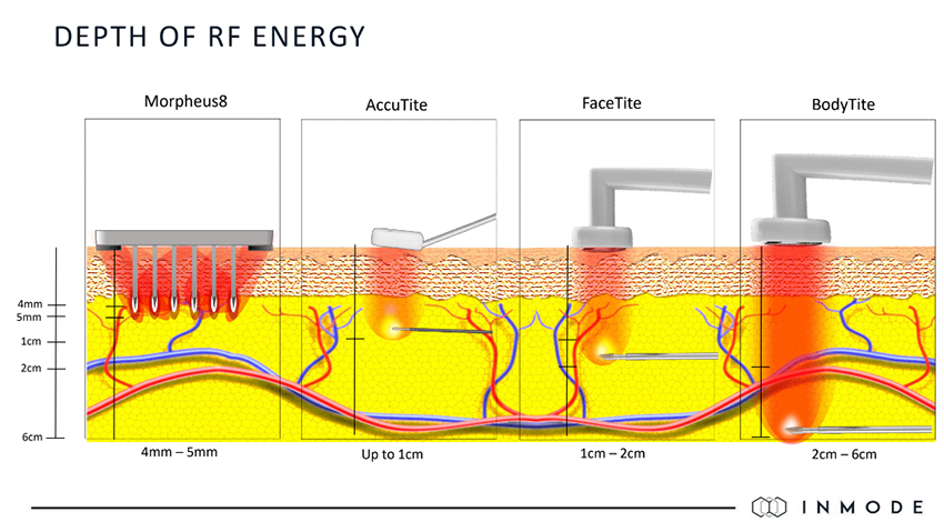 Depth of RF Engergy Graphic