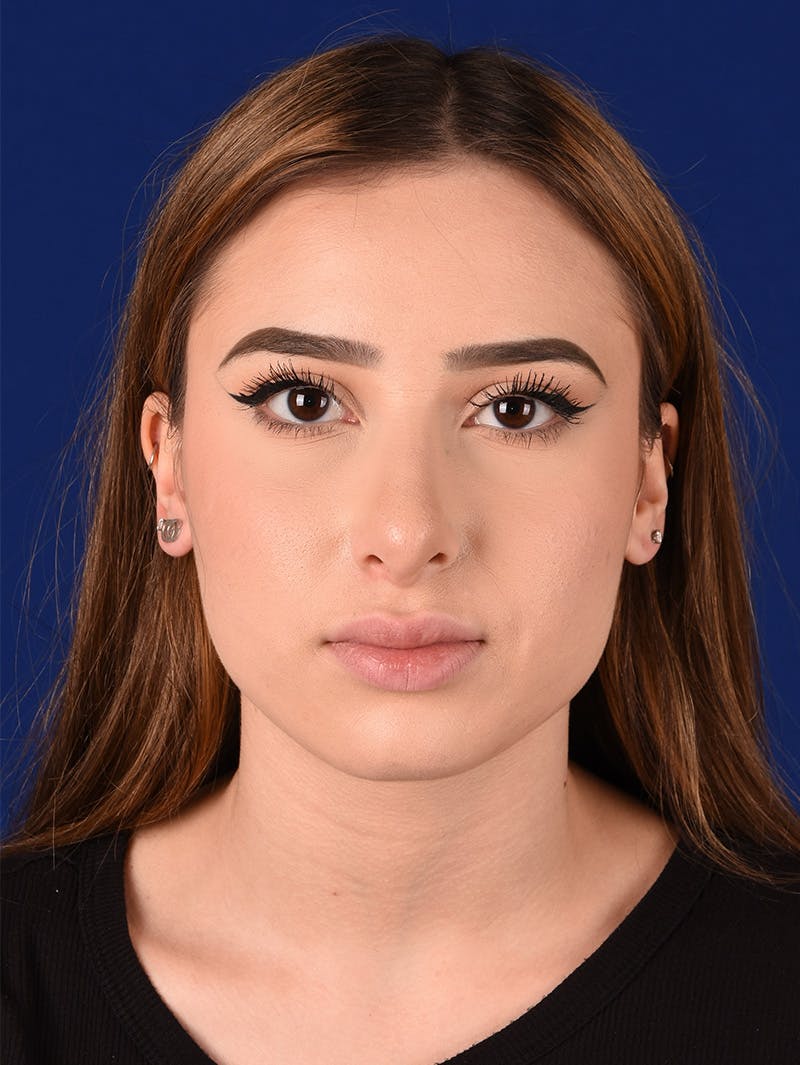 Female Rhinoplasty Before & After Gallery - Patient 114845878 - Image 1
