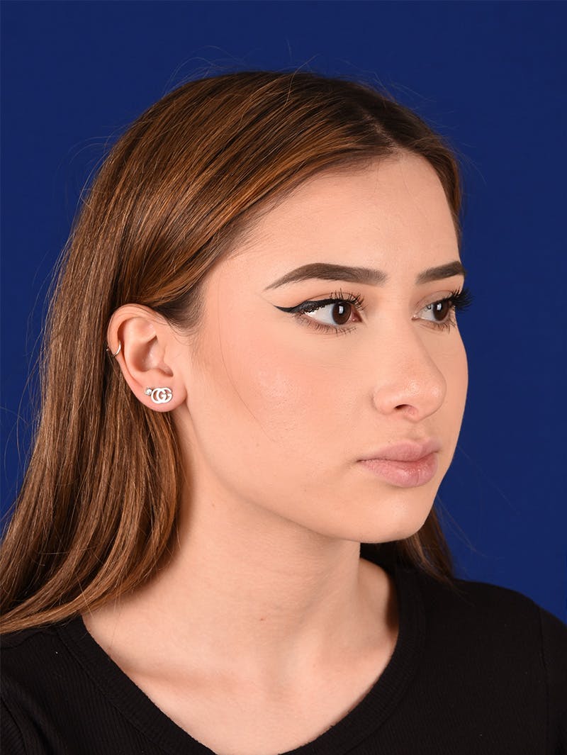 Female Rhinoplasty Before & After Gallery - Patient 114845878 - Image 3