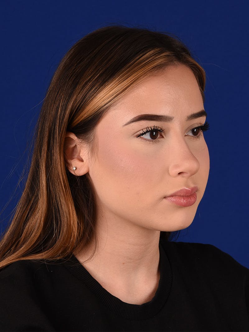 Female Rhinoplasty Before & After Gallery - Patient 114845878 - Image 4
