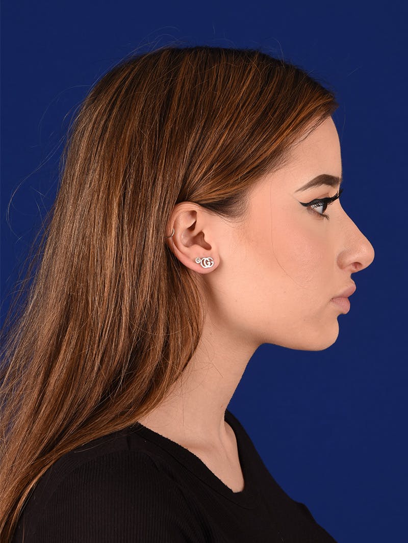 Female Rhinoplasty Before & After Gallery - Patient 114845878 - Image 5