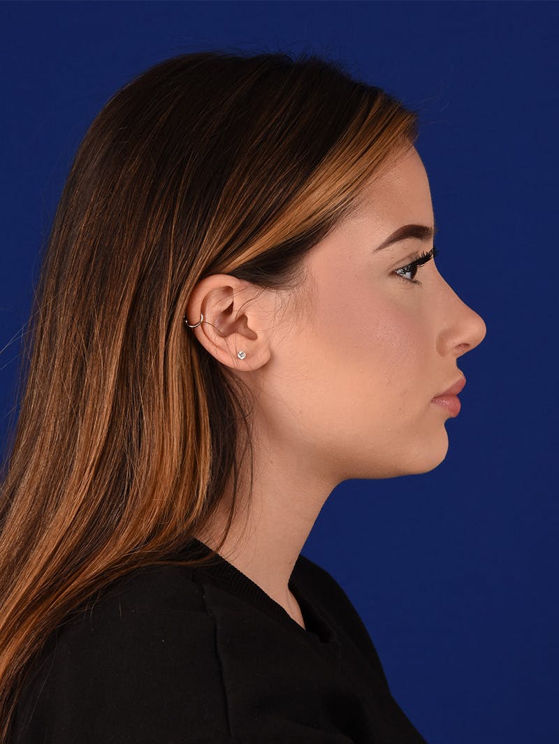 Female Rhinoplasty Before & After Gallery - Patient 114845878 - Image 6