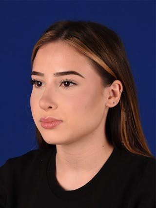 Female Rhinoplasty Before & After Gallery - Patient 114845878 - Image 8