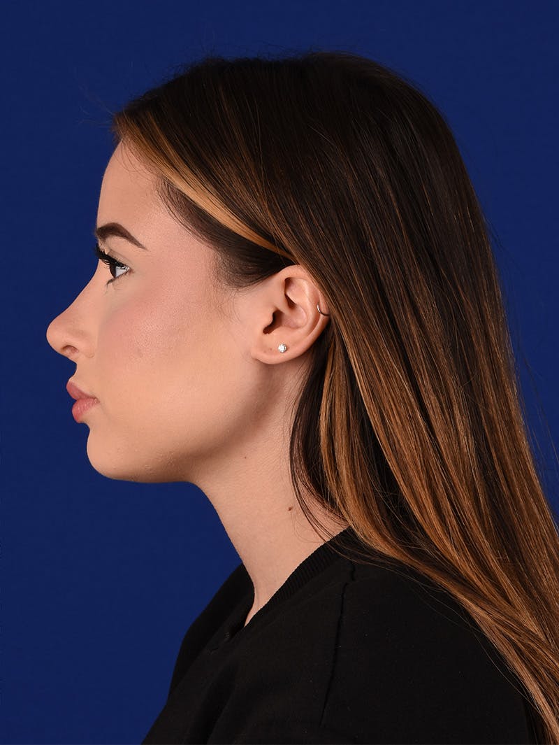 Female Rhinoplasty Before & After Gallery - Patient 114845878 - Image 10