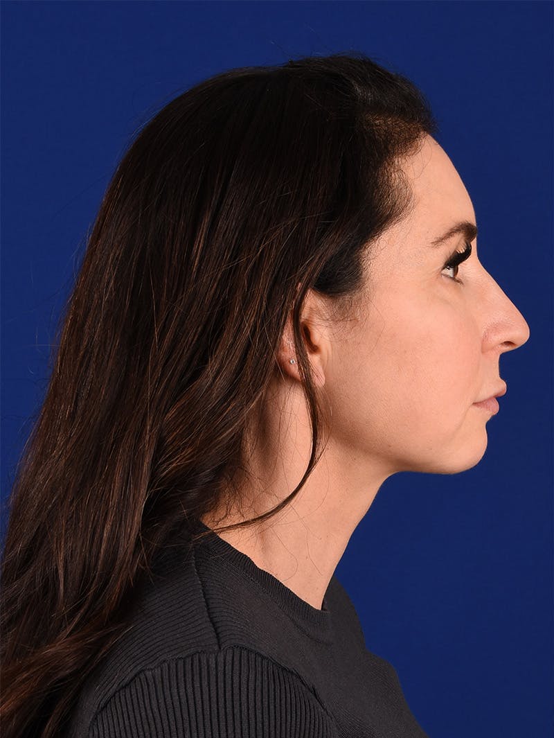 Female Rhinoplasty Before & After Gallery - Patient 114846968 - Image 5
