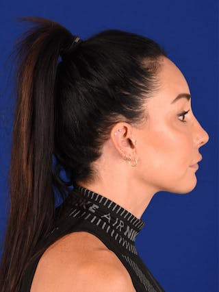 Facelift Before & After Gallery - Patient 114851630 - Image 6