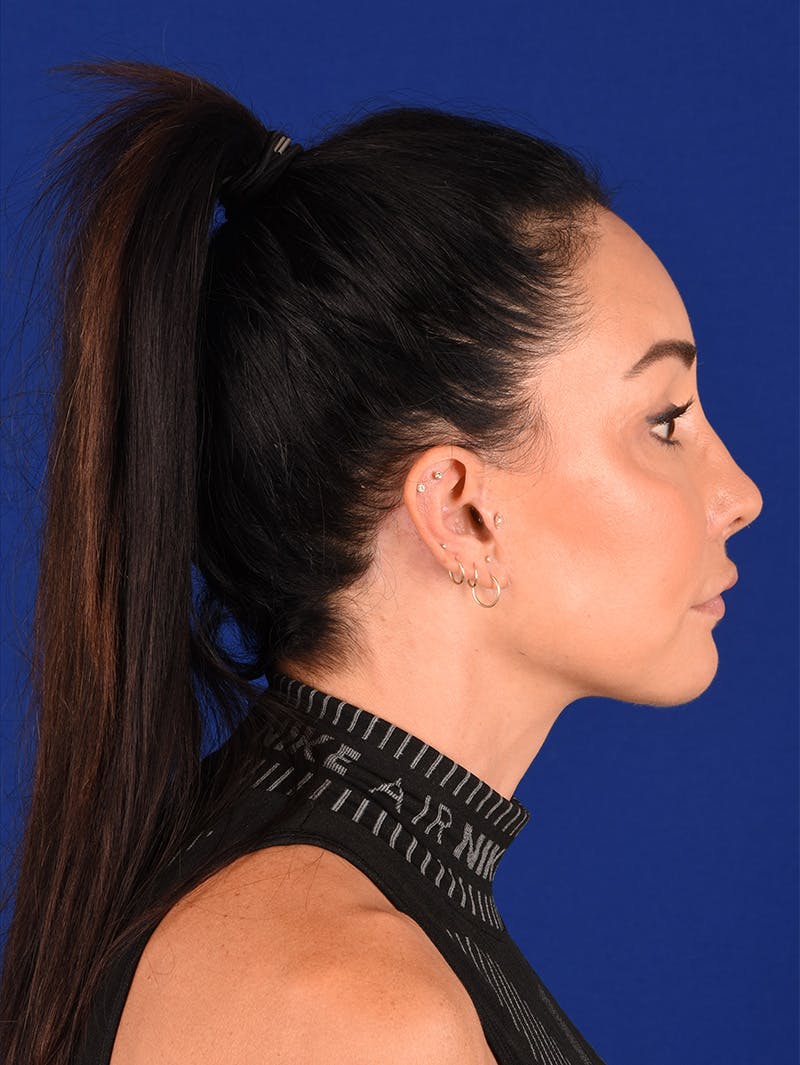 Female Rhinoplasty Before & After Gallery - Patient 114846968 - Image 6