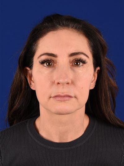 Facelift Before & After Gallery - Patient 114851630 - Image 1