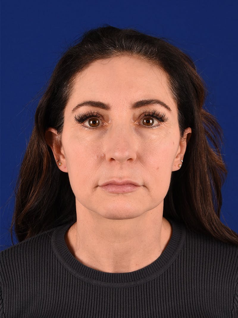 Facelift Before & After Gallery - Patient 114851630 - Image 1