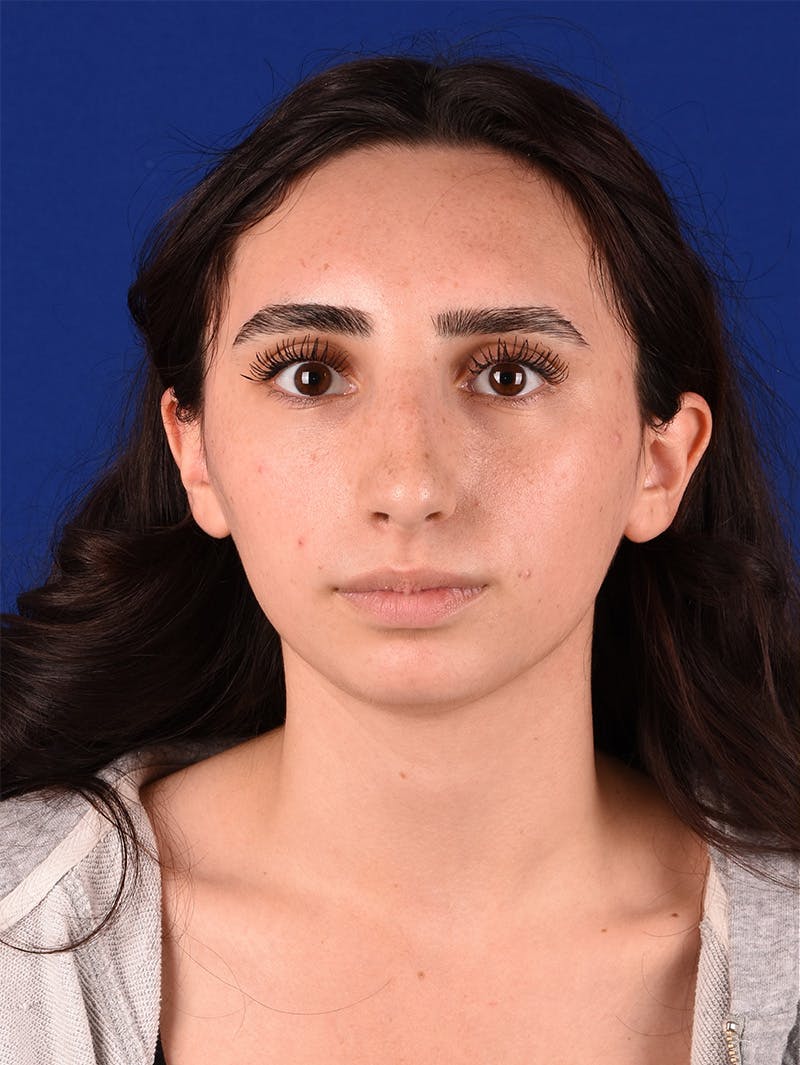 Female Rhinoplasty Before & After Gallery - Patient 114849286 - Image 1