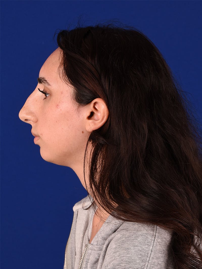Female Rhinoplasty Before & After Gallery - Patient 114849286 - Image 3