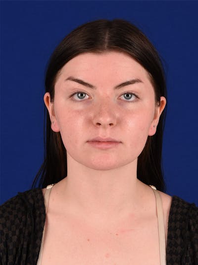 Female Rhinoplasty Before & After Gallery - Patient 114849379 - Image 1