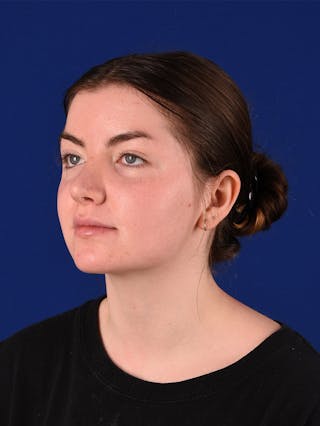 Female Rhinoplasty Before & After Gallery - Patient 114849379 - Image 4