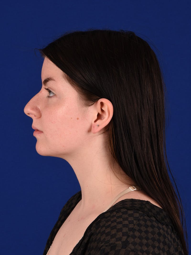 Female Rhinoplasty Before & After Gallery - Patient 114849379 - Image 5