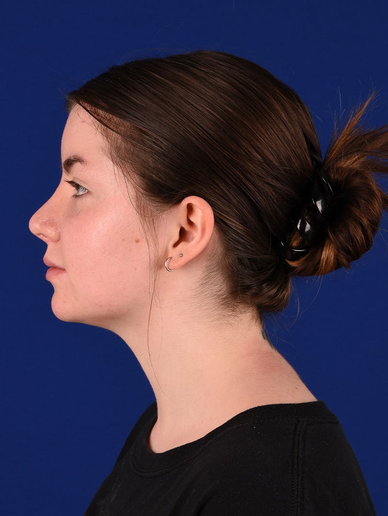 Female Rhinoplasty Before & After Gallery - Patient 114849379 - Image 6