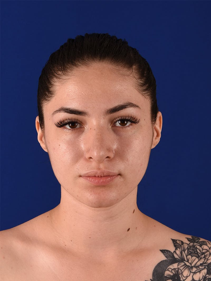 Female Rhinoplasty Before & After Gallery - Patient 114850061 - Image 1