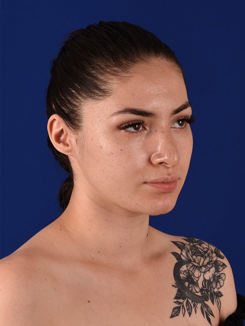 Female Rhinoplasty Before & After Gallery - Patient 114850061 - Image 3