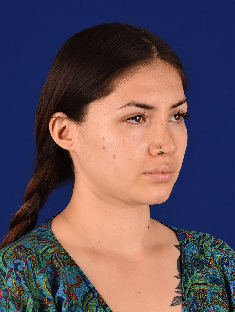 Female Rhinoplasty Before & After Gallery - Patient 114850061 - Image 4