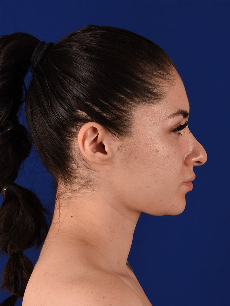 Female Rhinoplasty Before & After Gallery - Patient 114850061 - Image 5
