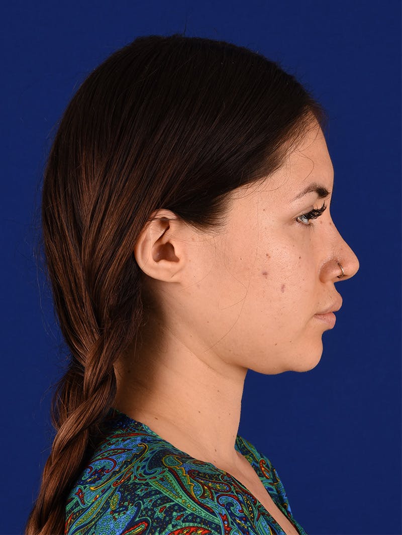 Female Rhinoplasty Before & After Gallery - Patient 114850061 - Image 6