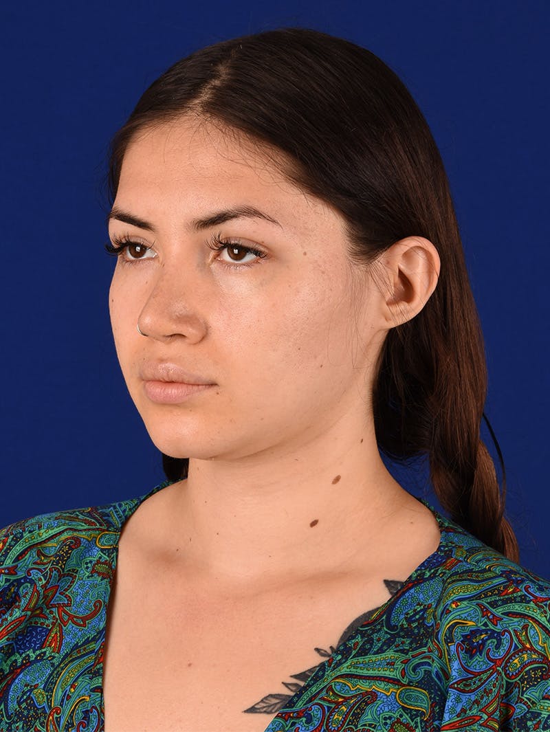 Female Rhinoplasty Before & After Gallery - Patient 114850061 - Image 8