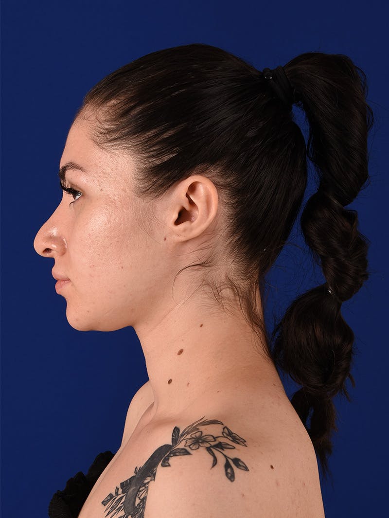 Female Rhinoplasty Before & After Gallery - Patient 114850061 - Image 9