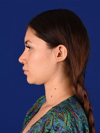 Female Rhinoplasty Before & After Gallery - Patient 114850061 - Image 10