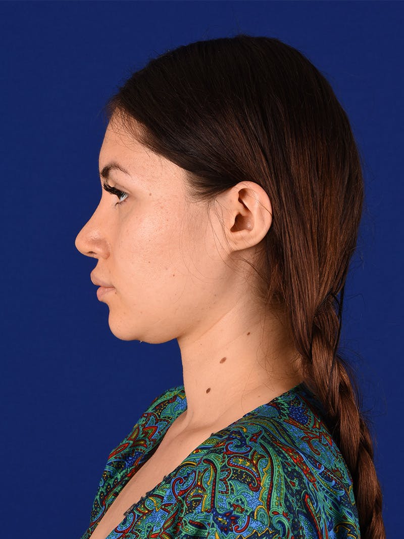 Female Rhinoplasty Before & After Gallery - Patient 114850061 - Image 10