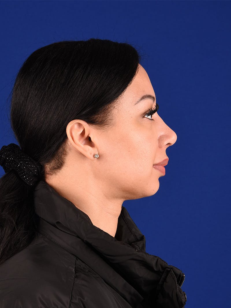Female Rhinoplasty Before & After Gallery - Patient 114850127 - Image 6