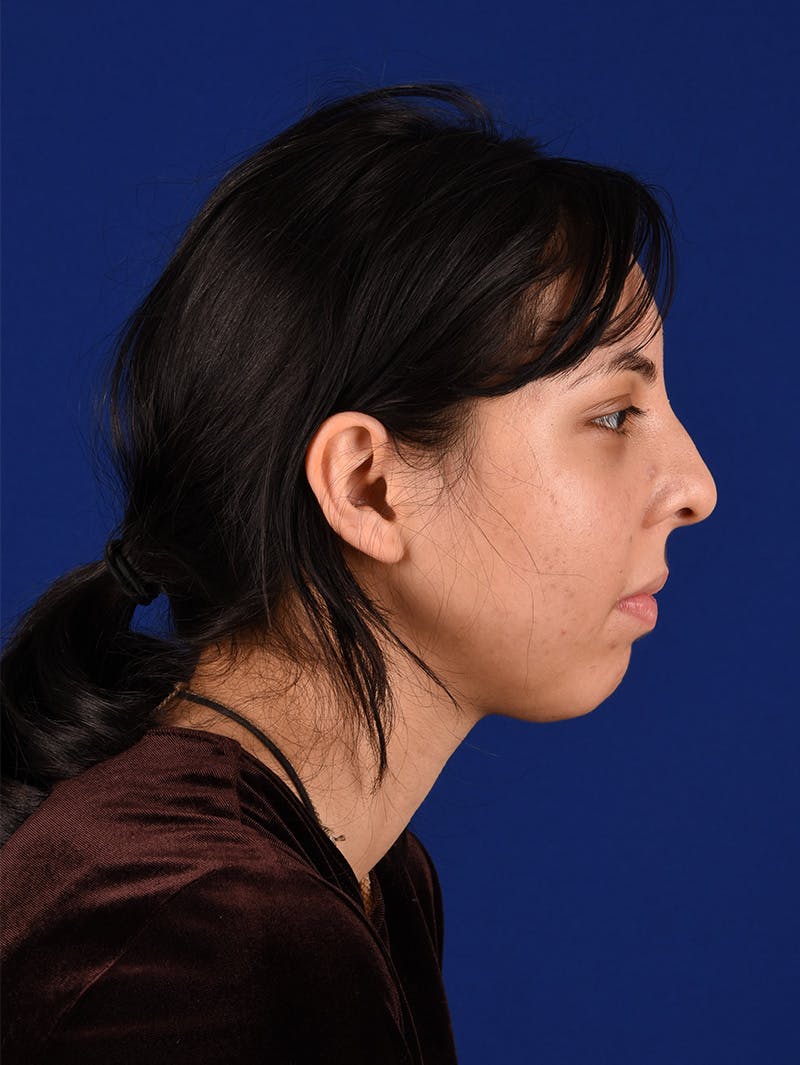 Female Rhinoplasty Before & After Gallery - Patient 114850206 - Image 5