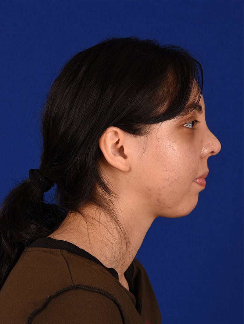 Female Rhinoplasty Before & After Gallery - Patient 114850206 - Image 6
