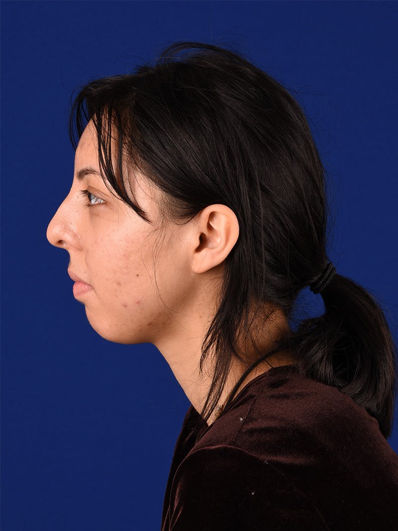 Female Rhinoplasty Before & After Gallery - Patient 114850206 - Image 9