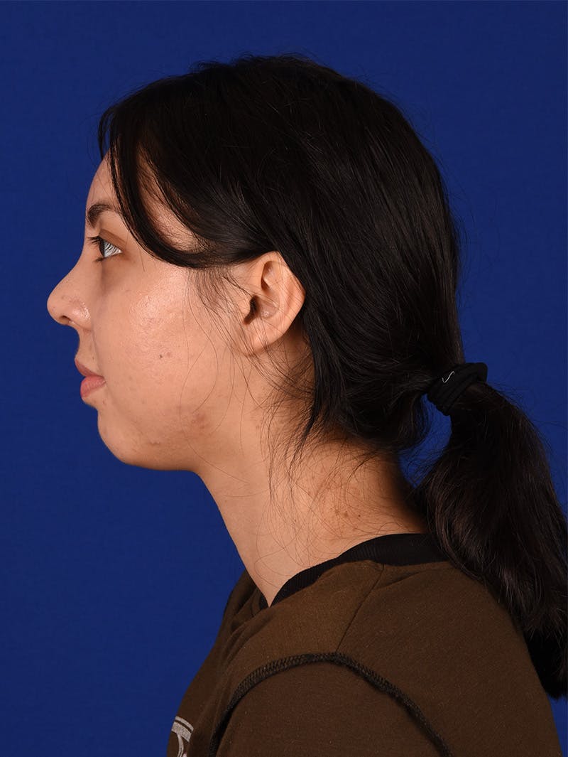 Female Rhinoplasty Before & After Gallery - Patient 114850206 - Image 10