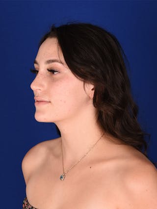 Female Rhinoplasty Before & After Gallery - Patient 114850904 - Image 4