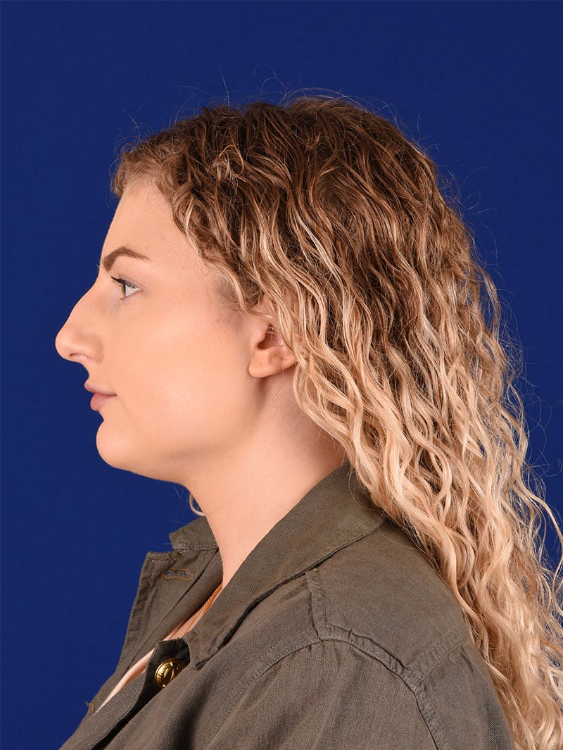 Female Rhinoplasty Before & After Gallery - Patient 115978161 - Image 5