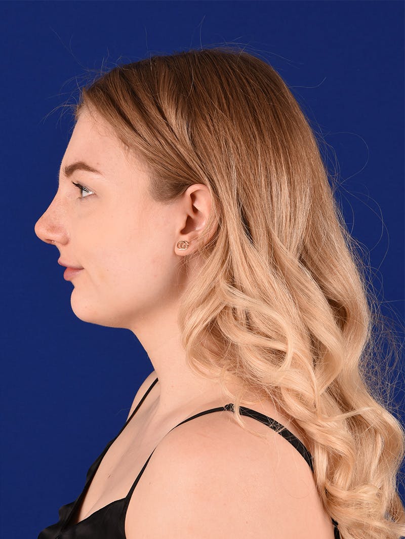 Female Rhinoplasty Before & After Gallery - Patient 115978161 - Image 6