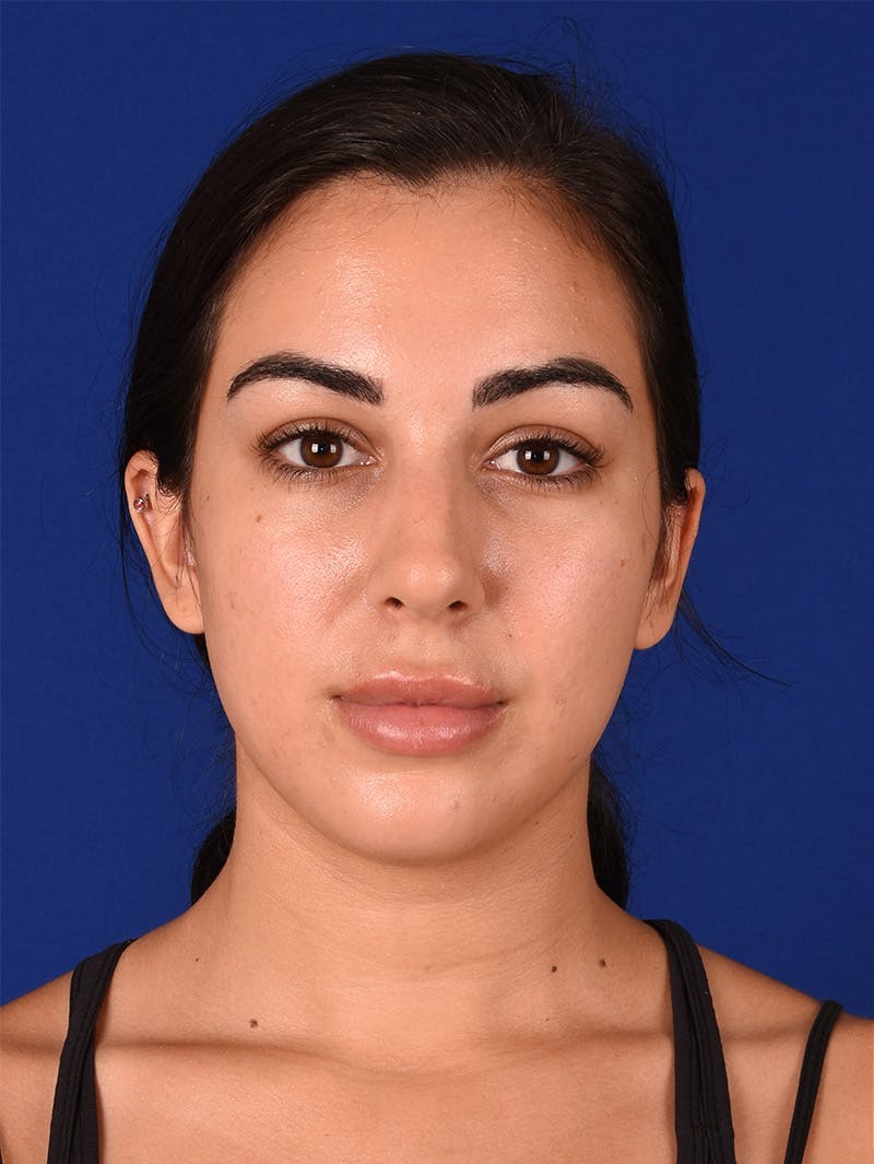 Female Rhinoplasty Before & After Gallery - Patient 115978323 - Image 1